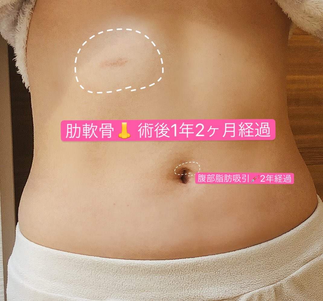 そぼろさん 傷跡経過 鼻の整形用に肋軟骨を取りましたが その手術経過を久々に まだまだ目立つな お酒では赤くならないタイプだけど 血流良くなると赤くなるので尚目立つ ついでに脂肪吸引の傷痕もおへその部分が少し見えるので印つけ
