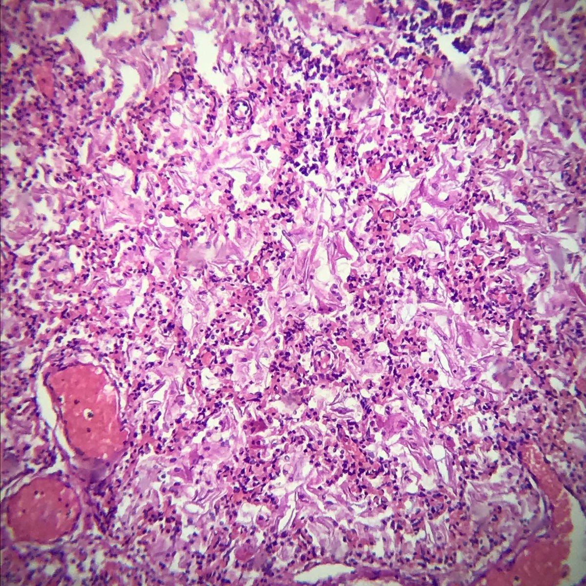 AlisaYashchenko's tweet photo. Amniotic Fluid Aspiration🔬
#path #pathology #histology #medicine https://t.co/lNUYf1fGVb