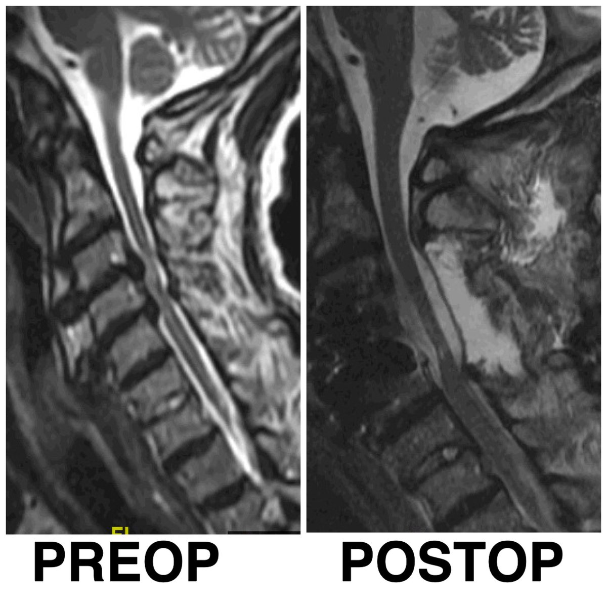 AmritChiluwalMD's tweet photo. Severe cervical spinal cord compression, patient unable to walk for 10 days - cord circumferentially decompressed, with improvement of his motor function. @JamaicaHospital @drshamikc @MohsenNouriMD #cervical360 #anteriorcervical #acdf #corpectomy #posteriorcervical https://t.co/Vpn5HB6JNE