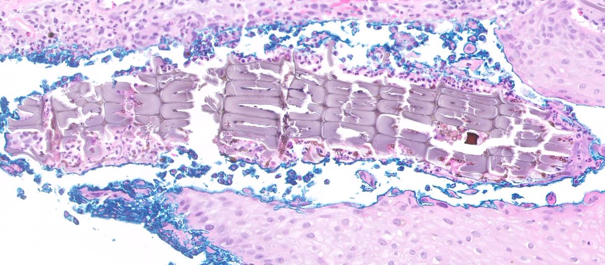 JCloutierMD's tweet photo. "Rule out BCC"  🧐 🪙

#dermpath https://t.co/fsFSl26lLW