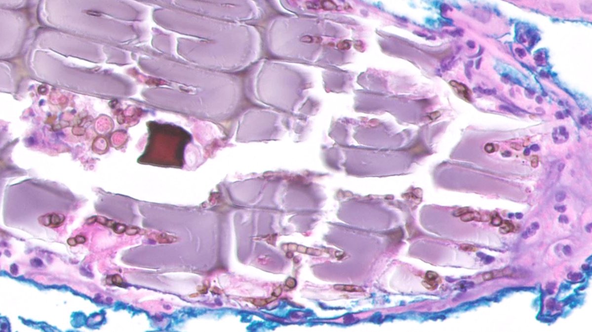 JCloutierMD's tweet photo. "Rule out BCC"  🧐 🪙

#dermpath https://t.co/fsFSl26lLW