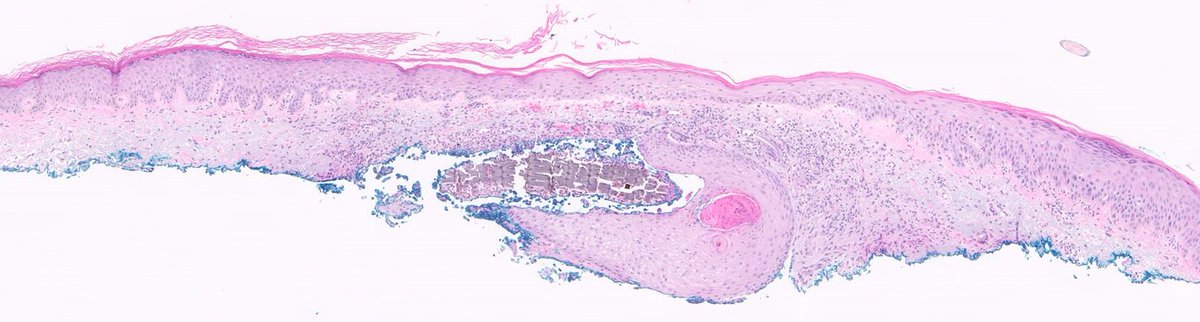 JCloutierMD's tweet photo. "Rule out BCC"  🧐 🪙

#dermpath https://t.co/fsFSl26lLW
