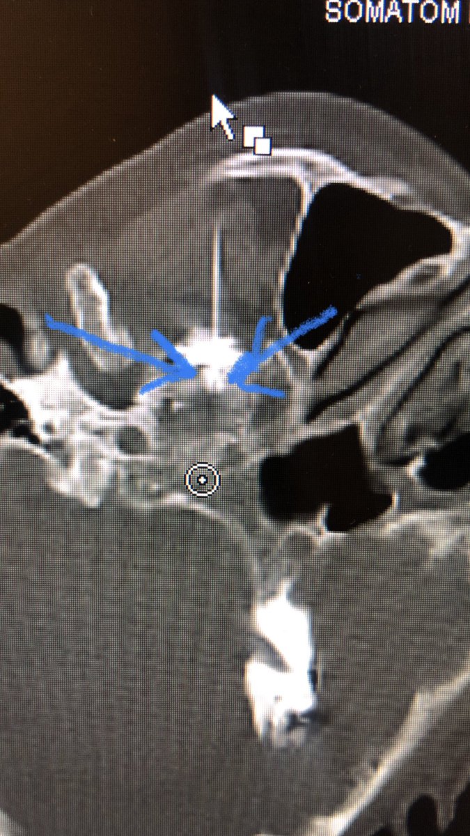 dougbeall's tweet image. CT is an underutilized modality for treating #Trigeminal #neuralgia with a nerve block. You can see the contrast going just into the the foramen ovale and around the gasserian ganglion (blue arrows)