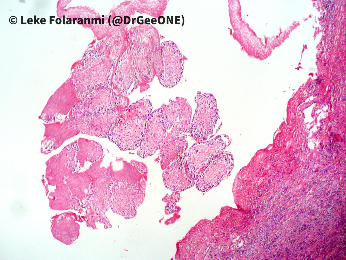 DrGeeONE's tweet photo. 1/2
Cystic tissue below the scapula in a 11 year old.
I'm not sure what this is. The fibrous capsule has lots of eosinophils, so I'm suspecting a parasite 🤔
@ParasiteGal @JMGardnerMD @dinesh_rakheja @cmdocpath
@alaboudkhalid
?#PathBug #CrittersOnTwitter https://t.co/9cdGvFmPrC