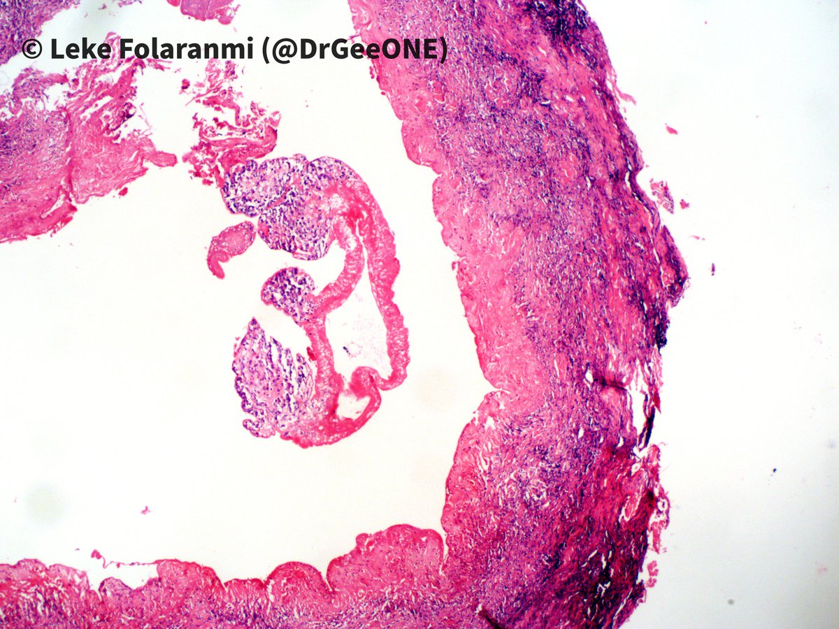 DrGeeONE's tweet photo. 1/2
Cystic tissue below the scapula in a 11 year old.
I'm not sure what this is. The fibrous capsule has lots of eosinophils, so I'm suspecting a parasite 🤔
@ParasiteGal @JMGardnerMD @dinesh_rakheja @cmdocpath
@alaboudkhalid
?#PathBug #CrittersOnTwitter https://t.co/9cdGvFmPrC
