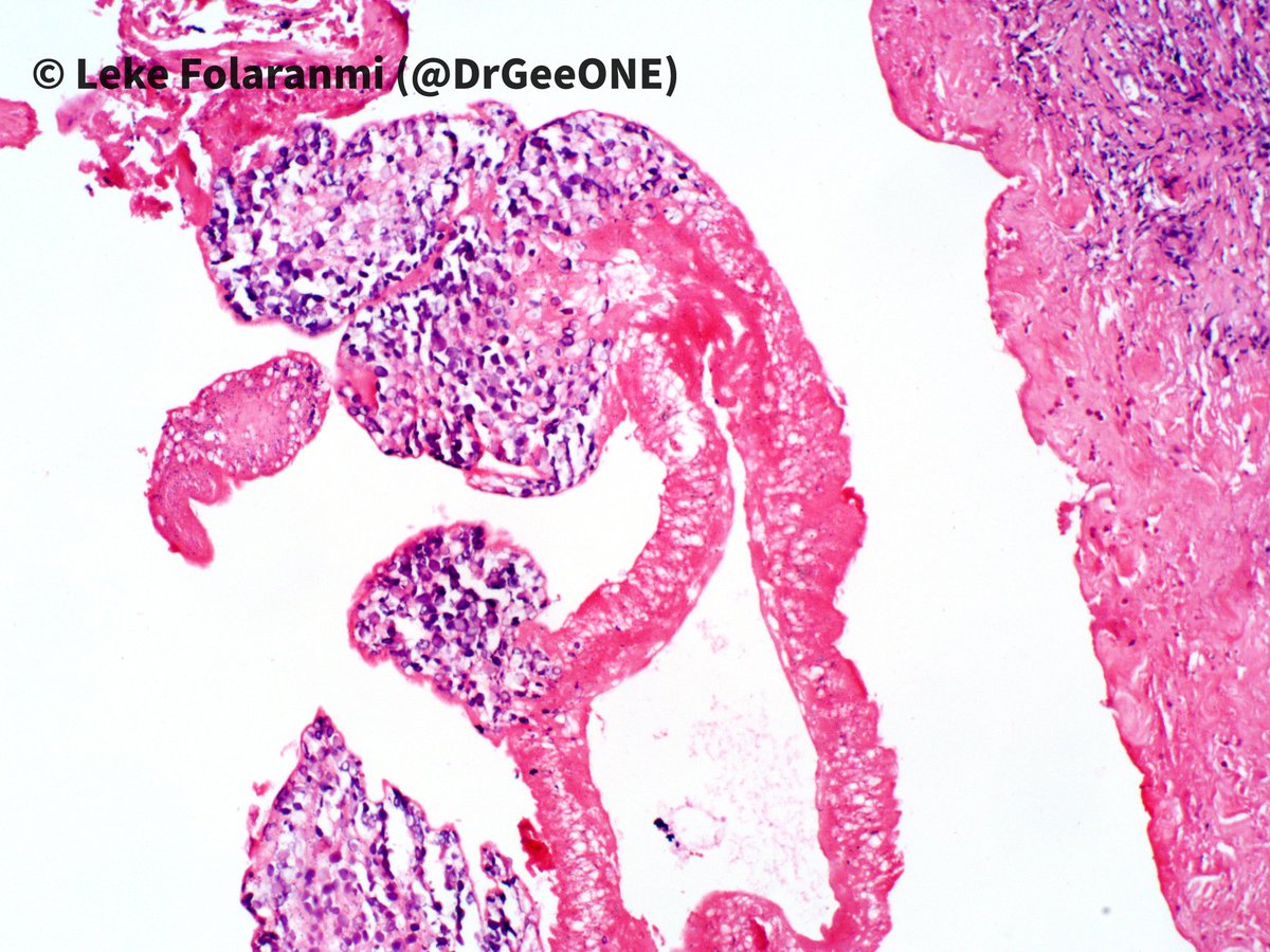 DrGeeONE's tweet photo. 1/2
Cystic tissue below the scapula in a 11 year old.
I'm not sure what this is. The fibrous capsule has lots of eosinophils, so I'm suspecting a parasite 🤔
@ParasiteGal @JMGardnerMD @dinesh_rakheja @cmdocpath
@alaboudkhalid
?#PathBug #CrittersOnTwitter https://t.co/9cdGvFmPrC