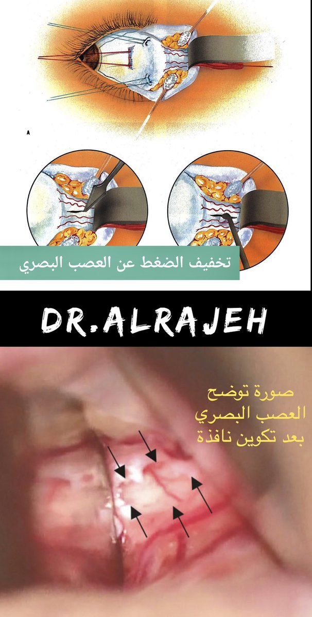 بتوفيق من الله تم عمل جراحة تخفيف ارتشاح العصب البصري الناتج من ارتفاع ضغط الدماغ بنجاح بدون مضاعفات و تحسن حدة الابصار بعد العملية و هي المرة الأولى التي تنفذ فيها هذا النوع من العمليات في <a href="/NGHAnews/">MNGHA</a> و أشكر زميلي العزيز طبيب الاعصاب <a href="/FaisalAlthekair/">Faisal Althekair</a> و اشرافه على فريق علاجي متكامل