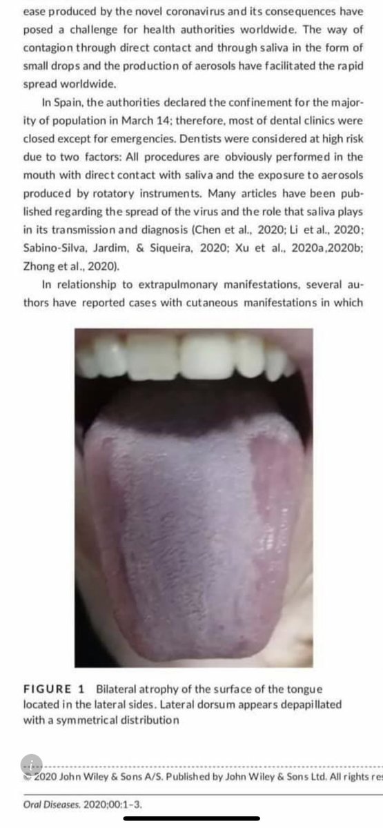 GameGnoahz's tweet photo. พึ่งรู้ว่า oral manifestation(อาการแสดง) ของโควิด-19 มี case report คือ น้ำลายแห้ง, แผลที่ลิ้น, การรับรสเปลี่ยน แผลที่เนื้อเยื่อในช่องปาก มีจุดเลือดออกตามเพดาน และเนื้อเยื่อในช่องปาก เนื่องจากเชื้อทำลายผนังหลอดเลือด โดยจับที่ ACE II receptorต่อมน้ำลาย (1) https://t.co/ft9iFAuXdf