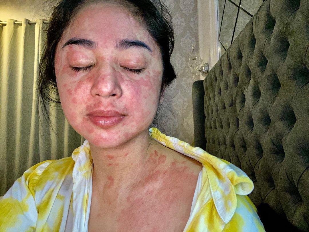 hitmusik_id's tweet photo. Terkena Covid-19, Kulit Dewi Persik Ruam, Ini Kata dr. Tirta

Selengkapnya di: https://t.co/iKkWZxeMiU

#DewiPerssik #Ruam #Covid19 #drtirta #HitMusik https://t.co/oah3FoeAa6