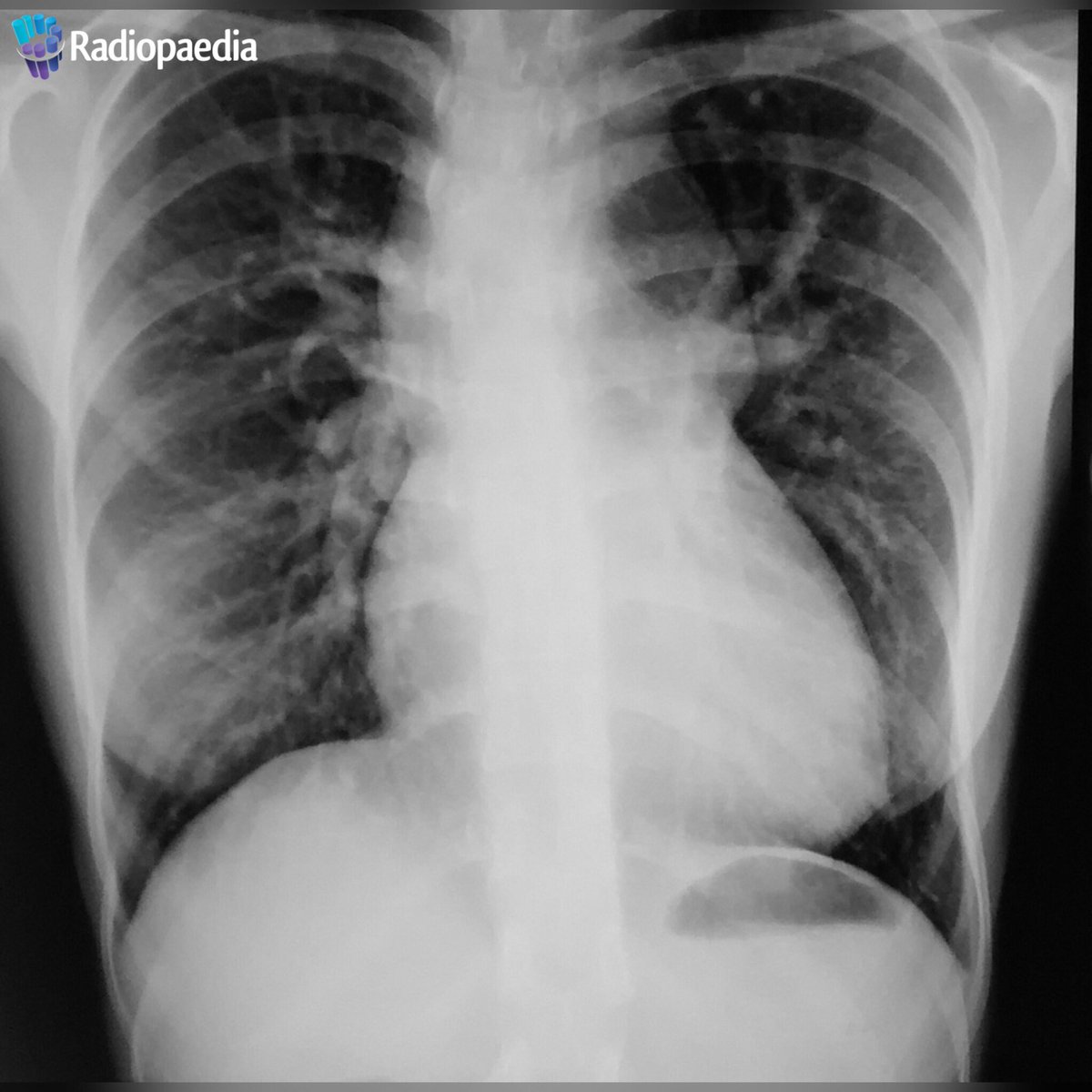 thexraydoctor's tweet photo. Three Christmas related imaging signs - can you name them on these @Radiopaedia cases?

#FOAMrad #FOAMed #radres https://t.co/p2d42HxJ6u