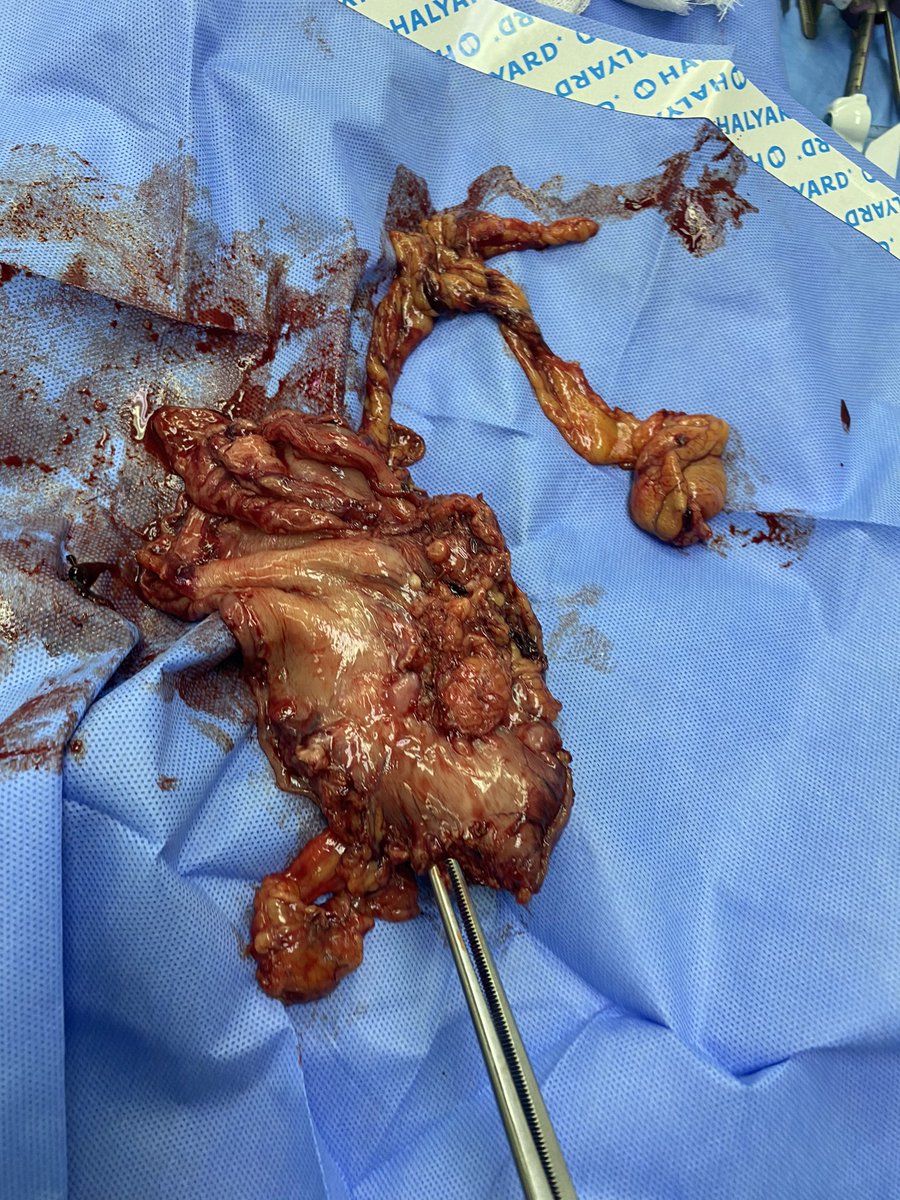 شكرا الشؤون الصحيه <a href="/hfrmoh/">فرع وزارة الصحة بحفرالباطن</a> على دعمنا للقيام بعمليه استئصال ورم بالمعده مع إزاله الغدد الليمفاوية D2 بالمنظار وخروج المريض بالسلامه شكرا للزملاء على مساعدتهم لي في العمليه واخص بالذكر الزميل د. تركي الشمري <a href="/drsurgeon23/">د.تركي الشمري/ Dr.Turki Alshammari</a> والدكتور عادل محجوب  والدكتوره ايمان