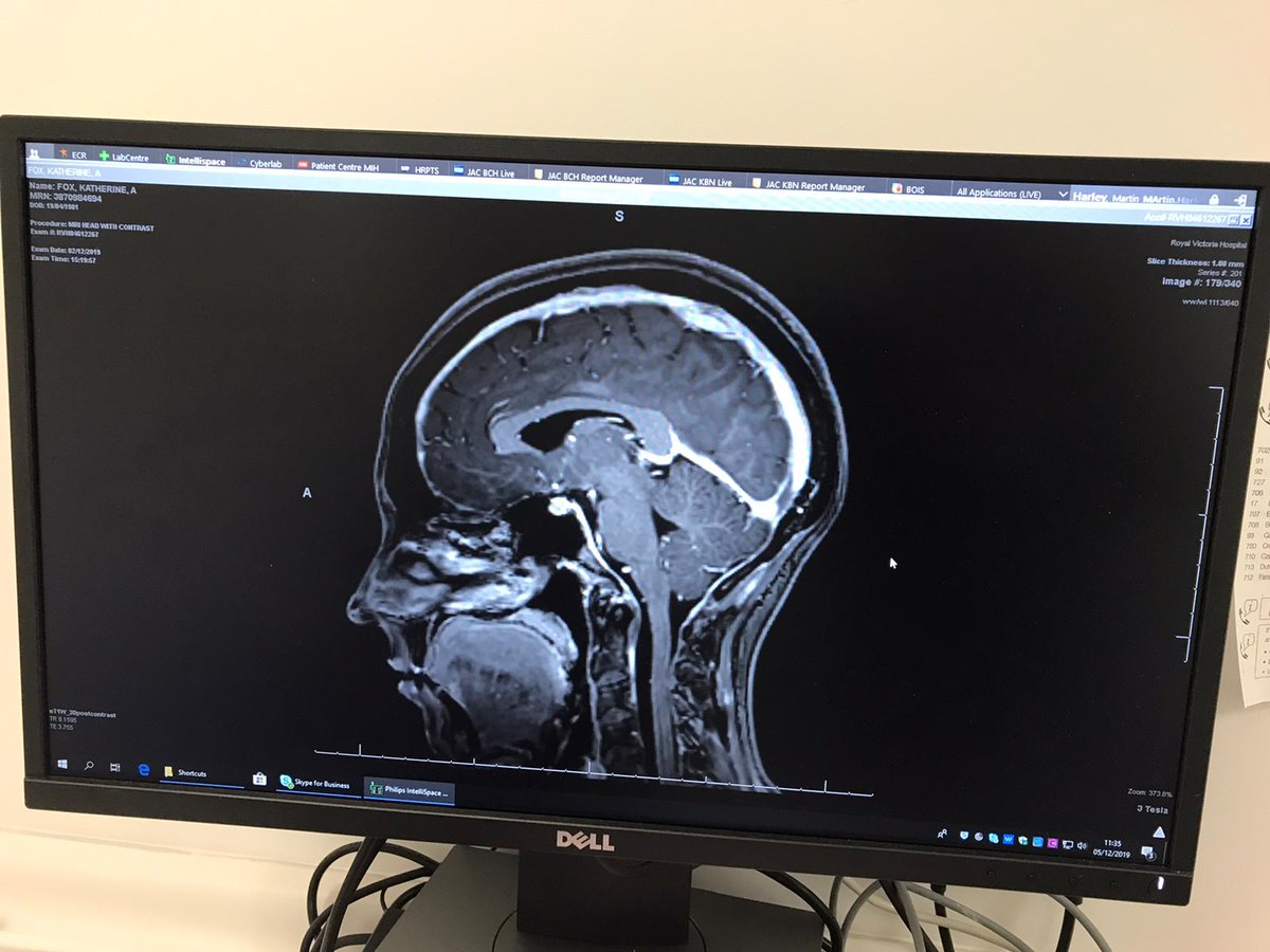 This time last year I was a miserable lump, lying in bed with a leaky brain. Very grateful to be upright this time round. 🤛