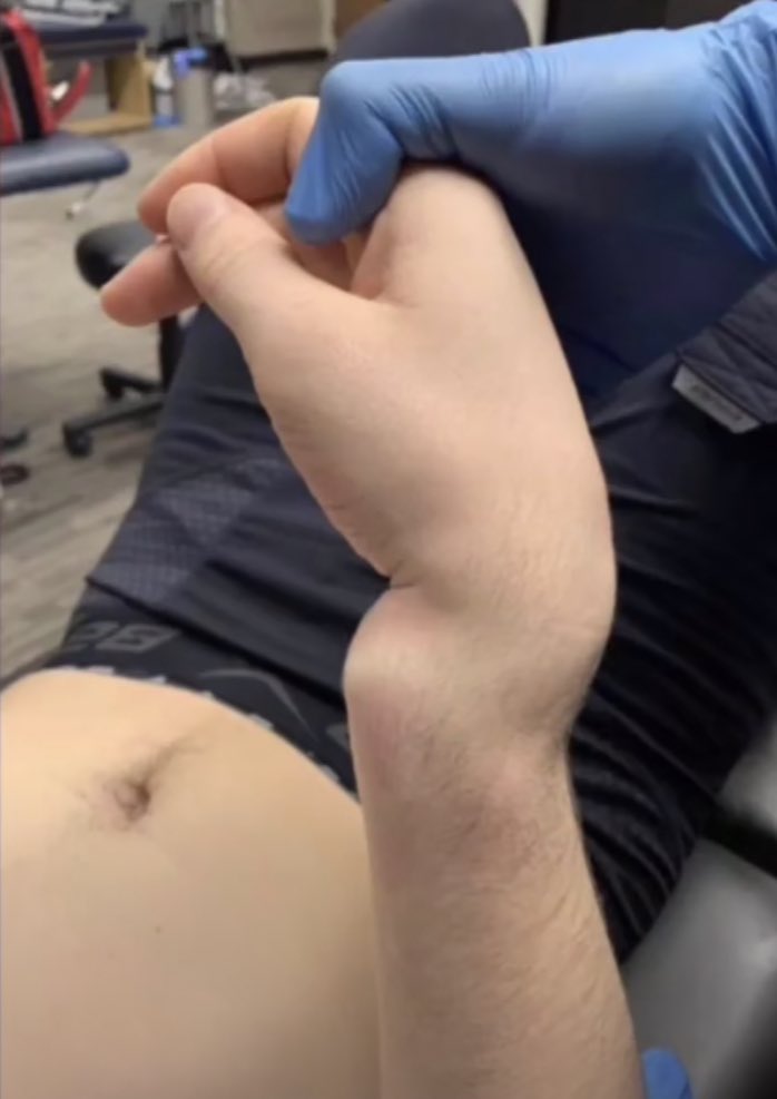Kirby Dach’s wrist from the Russia game on the 23rd
