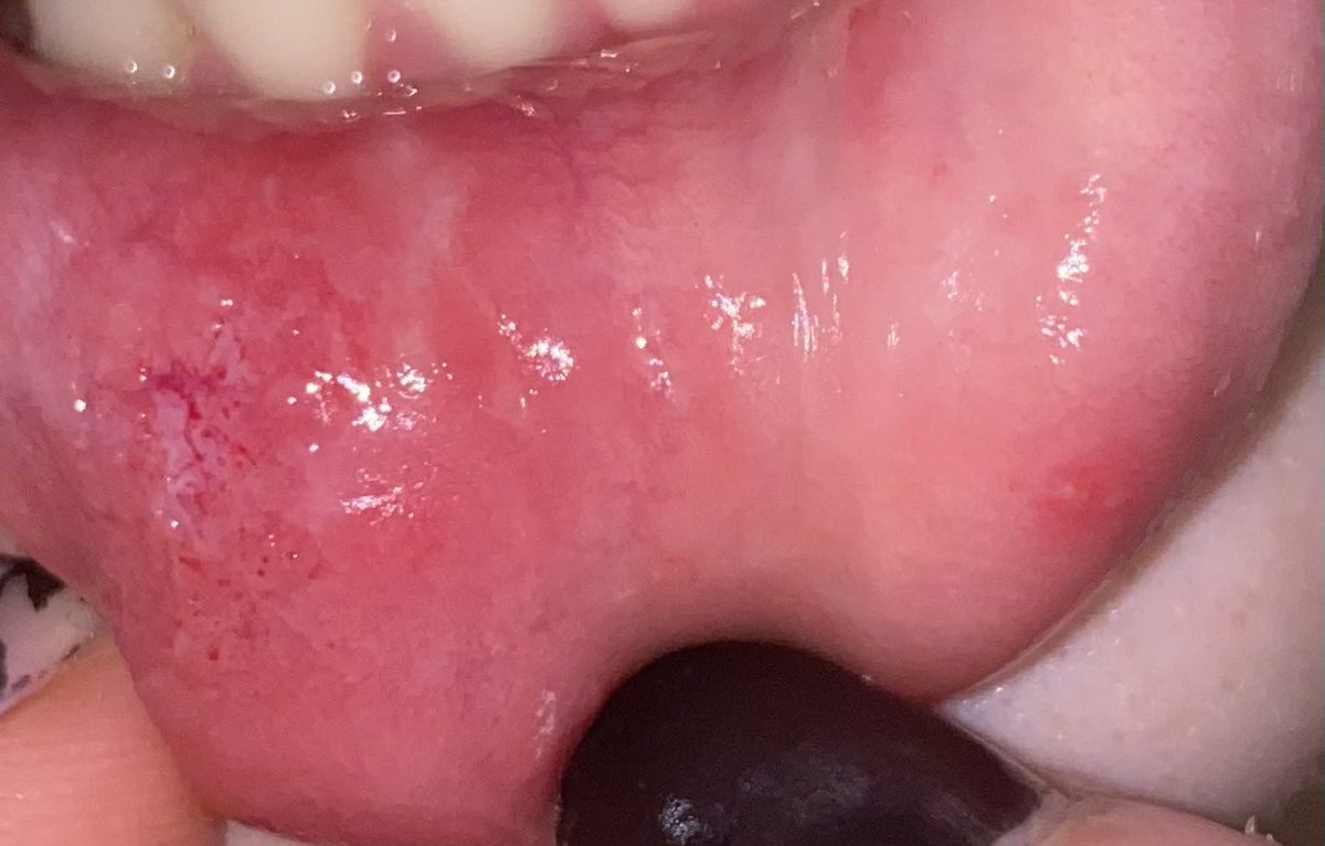 ratbraind's tweet photo. TW lip biting!!! Is this bad? Or will it heal easily? Didn’t know what I was doing fully #paintwt #shtwt #sh #ouchietwt https://t.co/DRP3QpryUO