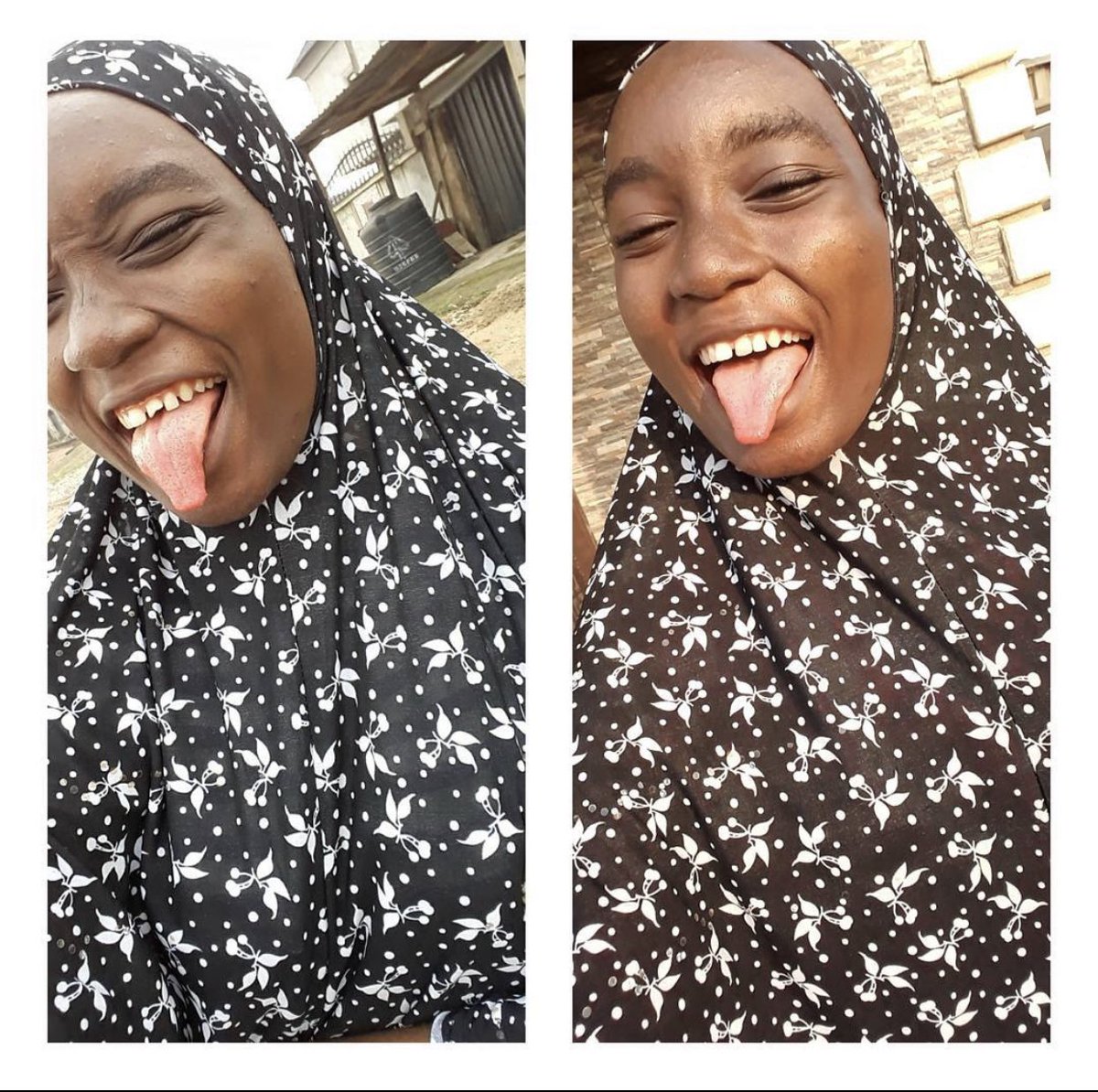 I remember how hard smiling for pictures was. I remember trying to run with the narrative that it made me unique, but you really cannot lie to yourself. In my third year, I found out that my NHIS in LUTH covered tooth filling. I hopped at it and got my tooth fixed! SEE BELOW!