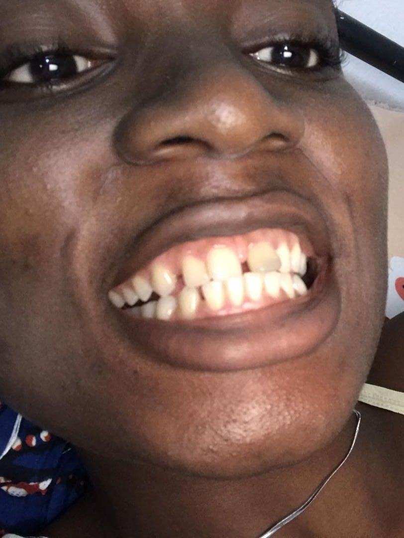 I felt more confident and I wondered why I didn't get it fixed earlier. A year down the line, I noticed that the tooth was getting discolored, and my insecurity was awoken. I reached out to another dentist to get it fixed, and I did. Here's how it was before I fixed it.