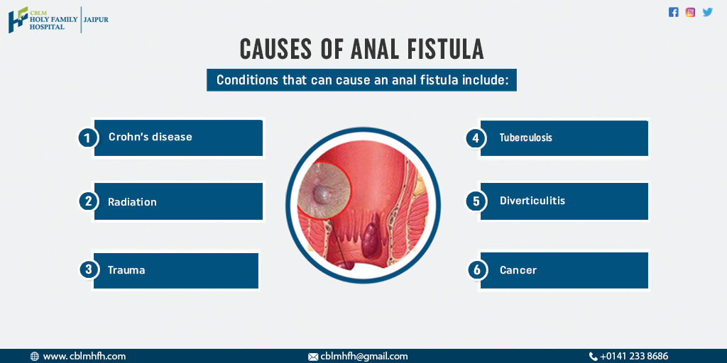 CBLMHFH's tweet image. Experts at CBLM Holy Family Hospital list out several symptoms causes of Anal Fistula.

To Know More About Causes Of Anal #Fistula
visit:- bit.ly/2LUeAuv or
Call:- 0141 233 8686 to book your appointment now.

 #pilonidalsurgery #pilonidal  #doctors #CBLMHFH #Jaipur