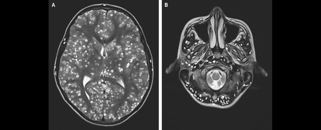 Il s'éteindra le 5 décembre 1991 d'une crise cardiaque la veille de ses 50ans.Une autopsie sera effectuée notamment sur son cerveau car celui-ci révèlera beaucoup d'anomalies. Mais étrangement, celui-ci aurait disparu du jour au lendemain sans laisser de traces.