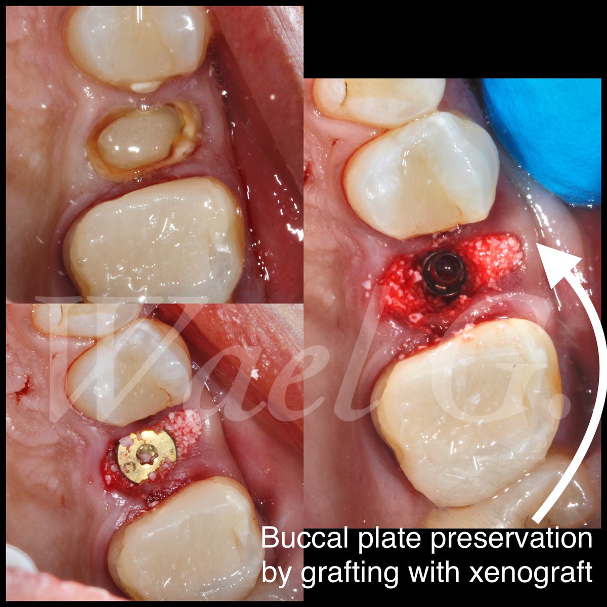 DrWaelPros's tweet photo. Management of hopeless tooth by extraction and immediate implant placement and immediate provisional.
The bottom photo shows final screw retained zirconia crown.

#طب_الاسنان #dentistry https://t.co/GI771obRXY