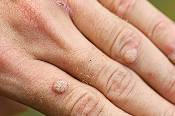 hpv flat warts