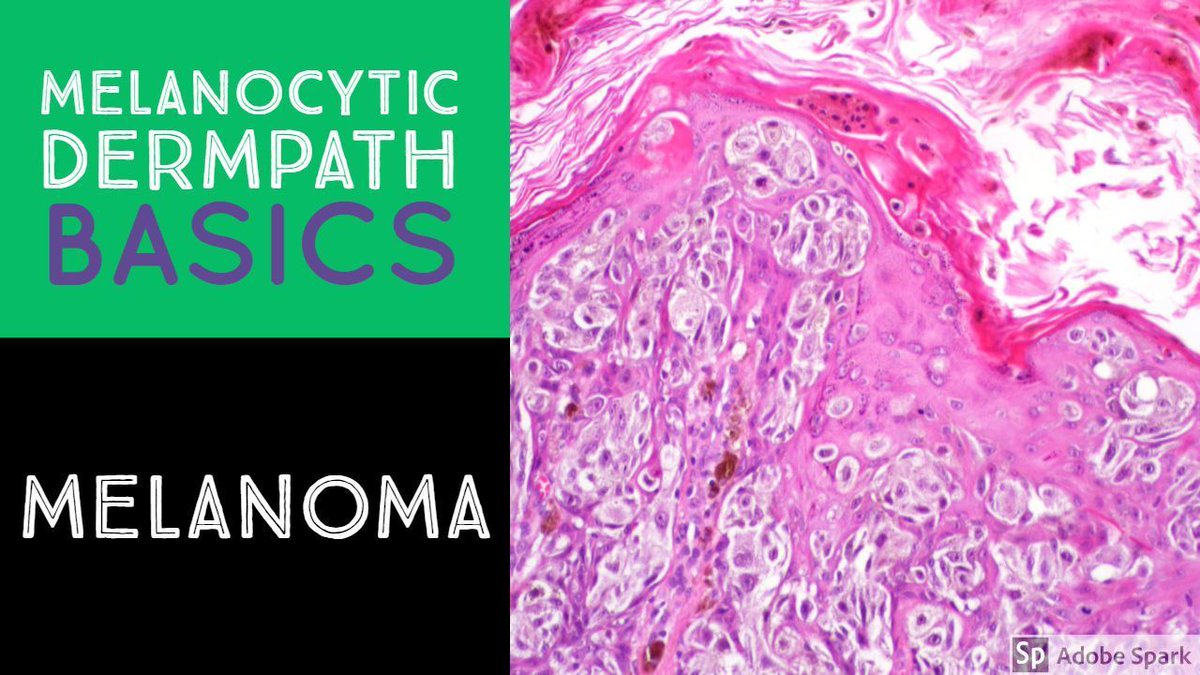 JMGardnerMD's tweet image. Learn the basic #pathology features of #melanoma in my video: kikoxp.com/posts/3764. Here's a video on nevus basics too: kikoxp.com/posts/3740. Learn maturation, pagetoid, confluence, etc. #Pathology #dermpath #dermatology #dermtwitter #pathologists #pathTwitter #usmle #MedEd