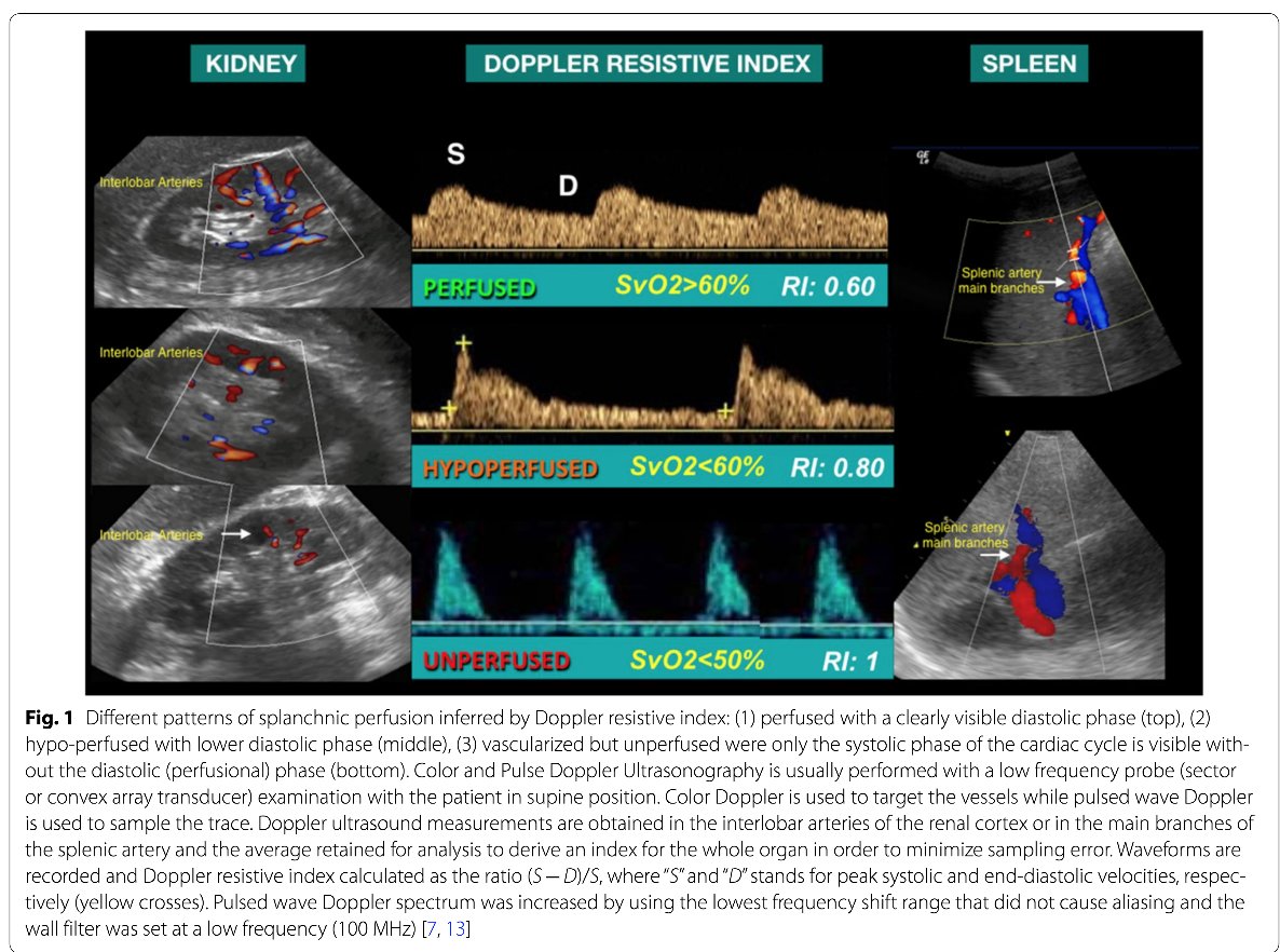 Great review w/nice #infographic @yourICM about #POCUS assessment of organ perfusion in critically ill pts for hypoperfusion in shock. Splanchnic organ perfusion Doppler evaluation as a potential diagnostic & monitoring tool for CV interactions assessment at bedside. #PedsICU