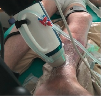 EJVES_ESVS's tweet photo. Effective and non-invasive treatment for a 95yo gentleman!
Read all about it #openaccess in #EJVESforum 
"Extracorporeal Treatment with High Intensity Focused US of an Incompetent Perforating Vein in a Patient with Active Venous Ulcers" by A Obermayer

https://t.co/U4MEjH9RlX https://t.co/4KJb2G3xCL