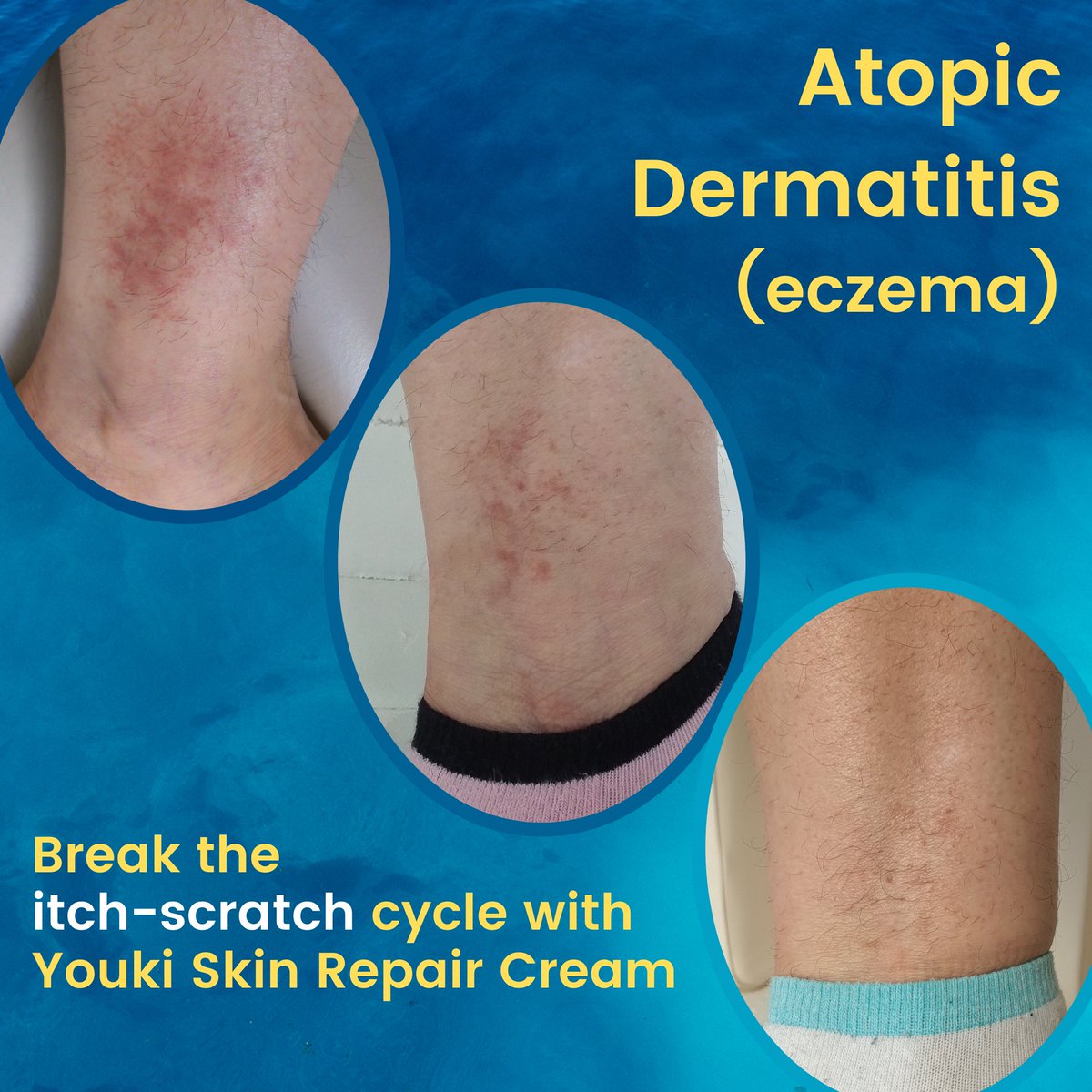 Clinogen's tweet photo. It’s estimated that 15m people in the UK suffer with eczema. Youki Skin Repair Cream helps to break the itch–scratch cycle and reduce inflammation https://t.co/2LU8VvWYXn

#eczema #psoriasis #eczemarelief #dryskin #dermatitis #eczemahealing #eczemacure #eczemafree #eczemaskin https://t.co/AUdseBIZTq