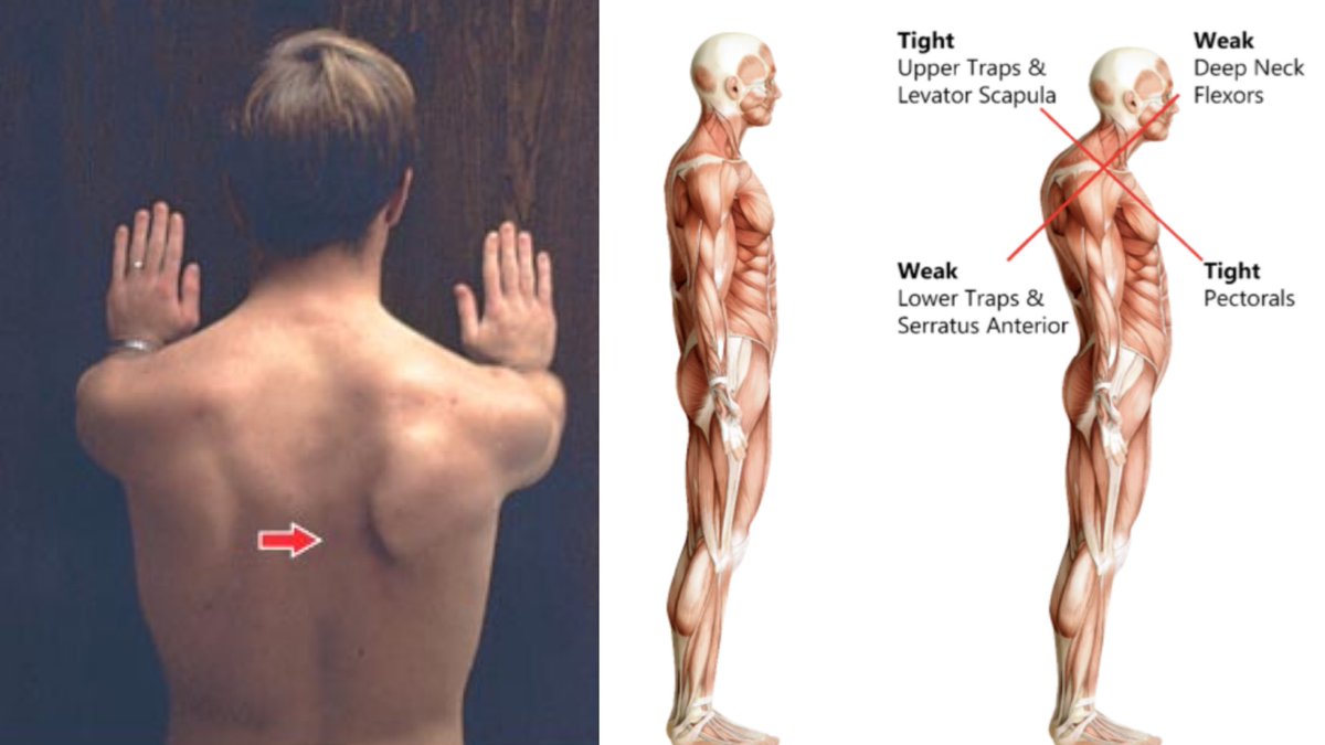 When the humerus is forward, it often takes the visual appears of a rounded shoulder posture & scapular winging.Usually in this circumstance, the lats & pecs are trying to be primary IR muscles because IR muscles at the rotator cuff like the subscapularis are limited.
