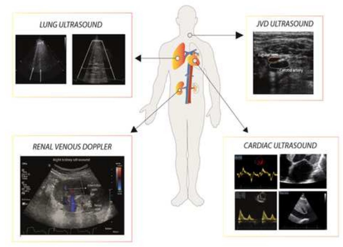  Congestión: valoraciónCA125  @JACCJournals  CA125 se asocia: congestión  o compuesto  y  IC  10.1016/j.jchf.2019.12.005 Valoración por eco  @ESC_Journals Cardiaca, pulmonar, renal y yugular. 10.1002/ejhf.2032