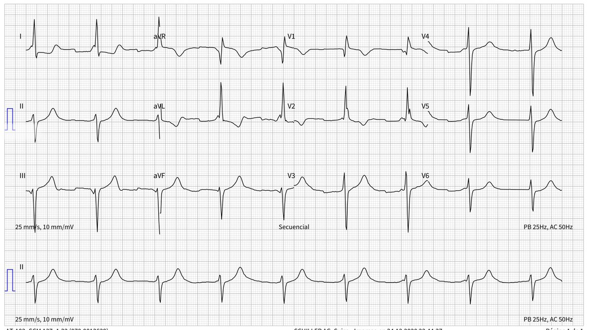 paomorejon's tweet image. Por este #ECG encontré esta revisión de @adribaran

bit.ly/34Mjkcl

#ECGFirst #CardioEd #CardioTwitter