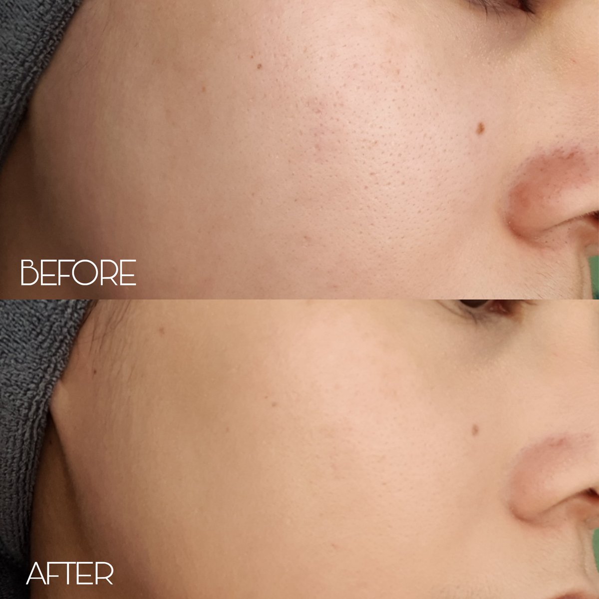 หลังตามหาสกินแคร์ลดสิวอุดตันมาสักพัก ในที่สุดก็เจอ <a href="/SkinsistaTH/">Skinsista Official</a> สูตรลดสิวอุดตัน ที่ร้านวัตสัน สุ่มใช้มามาสักพักไม่ผิดหวังเลย ช่วยคุมมันได้ดีมาก หลังใช้คือสิวอุดตันหลุดออกมาเลย ผิวเรียบเนียน คือดีอะ ไม่มีแอลกอฮอล์ พาราเบน ผิวแพ้ง่ายใช้ได้นะ ตอนนี้มีโปรลด 50% ด้วยจ้า #ใช้ดีบอกต่อ