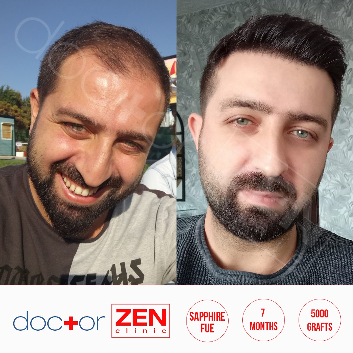 Doctor Zen Clinic On Twitter Doctor Zen Of Being Turkey S Best Clinic Invites You For Personalized Treatment To Aim For The Best Results More Information 90 542 231 48 33 Sagi Isaret Doctor Zen Clinic On Twitter Doctor Zen Of Being Turkey S Best Clinic Invites You For Personalized Treatment To Aim For The Best Results More Information 90 542 231 48 33 Sagi Isaret