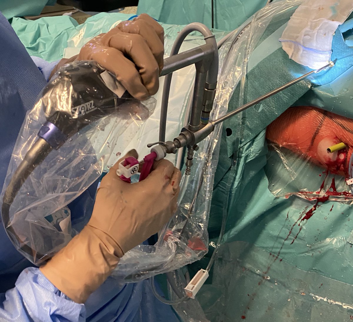 GuidoGiusti's tweet photo. In case of bulky stone the fastest way to clean up the kidney is big 30F sheath, combined lithotripter #shockpulse &amp; grasper #PERCX @rocamed to speed up #litholapaxis  #ETCE https://t.co/AqOd9kkiff