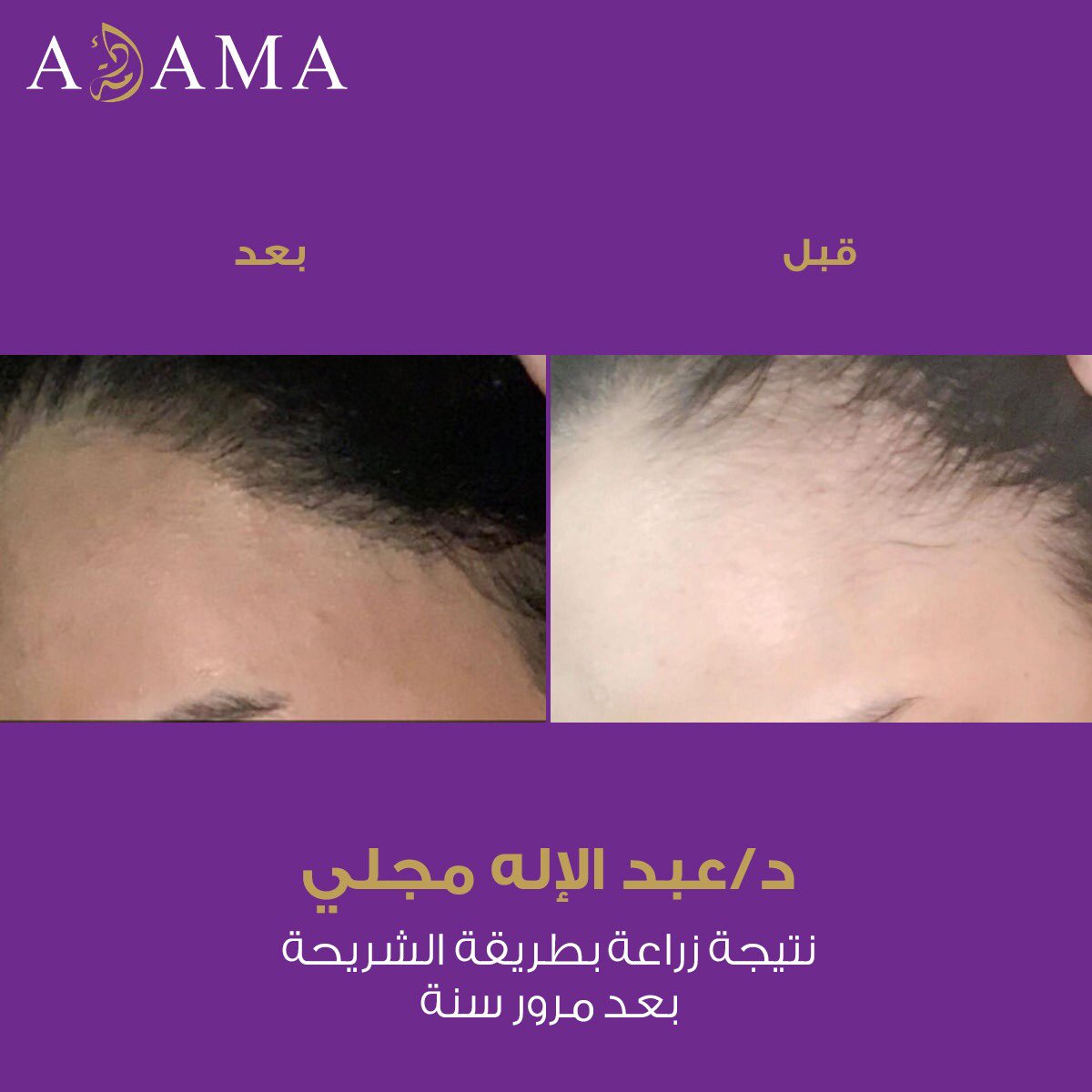 د عبدالاله مجلي Abhrs Haircare Twitter