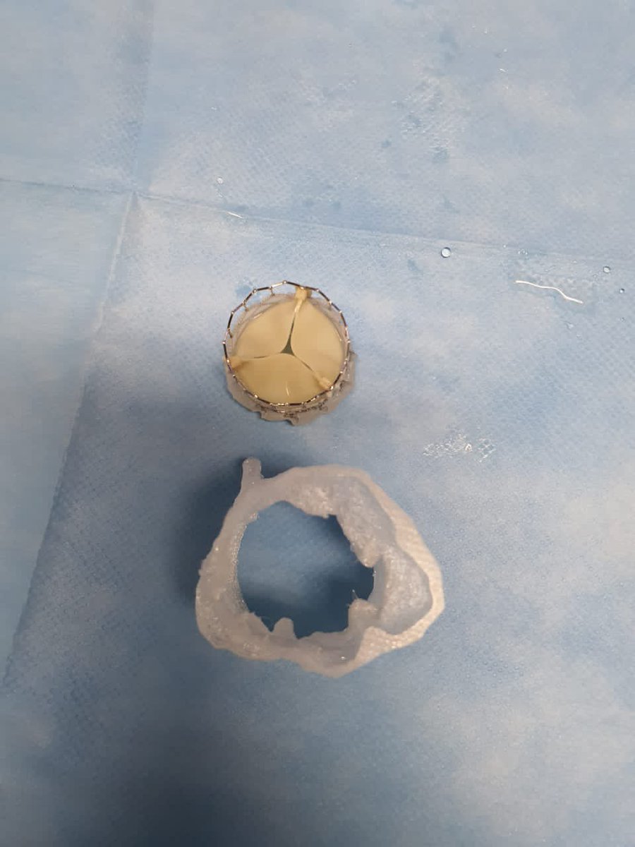 ROBERTO MURATALLA MD (@muratallamd) on Twitter photo <a href="/mirvatalasnag/">MIЯVΛƬ #IC ༄ 。°</a> <a href="/GilbertTangMD/">Dr. Gilbert Tang</a> <a href="/DrMauricioCohen/">Mauricio G. Cohen MD</a> <a href="/djc795/">David J. Cohen, MD, MSc</a> <a href="/rcstoler/">Robert Stoler MD</a> <a href="/SVRaoMD/">Sunil V. Rao</a> <a href="/AlcantaraCardio/">Marco Alcantara</a> <a href="/DraCardiopedia/">Dra. Luz Dinora S C</a> <a href="/modanira/">Julieta Morales P.</a> <a href="/drmerino75/">José Alfredo Merino Rajme</a> <a href="/caldera_99/">Angel Caldera</a> <a href="/MayraGuerreroMD/">Mayra Guerrero, MD</a> <a href="/JoaoLCavalcante/">João Cavalcante</a> <a href="/DeeDeeWangMD/">Dee Dee Wang MD</a> <a href="/OKhaliqueMD/">Omar Khalique</a> The both; to analyze the integrity of the Valve and academic skill. We will star with 3D printing and for us is importan to understand and modify future practice! <a href="/mirvatalasnag/">MIЯVΛƬ #IC ༄ 。°</a> <a href="/GilbertTangMD/">Dr. Gilbert Tang</a> <a href="/DrMauricioCohen/">Mauricio G. Cohen MD</a> <a href="/djc795/">David J. Cohen, MD, MSc</a> <a href="/rcstoler/">Robert Stoler MD</a> <a href="/SVRaoMD/">Sunil V. Rao</a> <a href="/AlcantaraCardio/">Marco Alcantara</a> <a href="/DraCardiopedia/">Dra. Luz Dinora S C</a> <a href="/modanira/">Julieta Morales P.</a> <a href="/drmerino75/">José Alfredo Merino Rajme</a> <a href="/caldera_99/">Angel Caldera</a> <a href="/MayraGuerreroMD/">Mayra Guerrero, MD</a> <a href="/JoaoLCavalcante/">João Cavalcante</a> <a href="/DeeDeeWangMD/">Dee Dee Wang MD</a> <a href="/OKhaliqueMD/">Omar Khalique</a> The both; to analyze the integrity of the Valve and academic skill. We will star with 3D printing and for us is importan to understand and modify future practice!