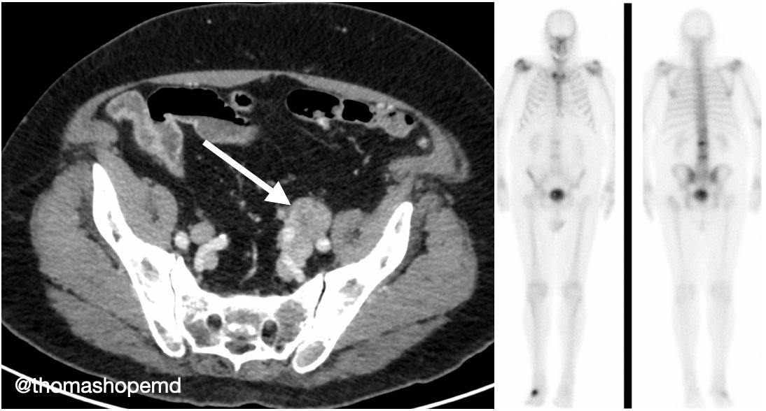1/ Would you order a  #PSMAPET in a patient post-RP with BCR and N1 disease on conventional imaging? What about this patient? PSA rose from 0.3 to over 50 in three years after surgery. 2.8 cm left pelvic node on CT with no other sites of disease including a negative bone scan.