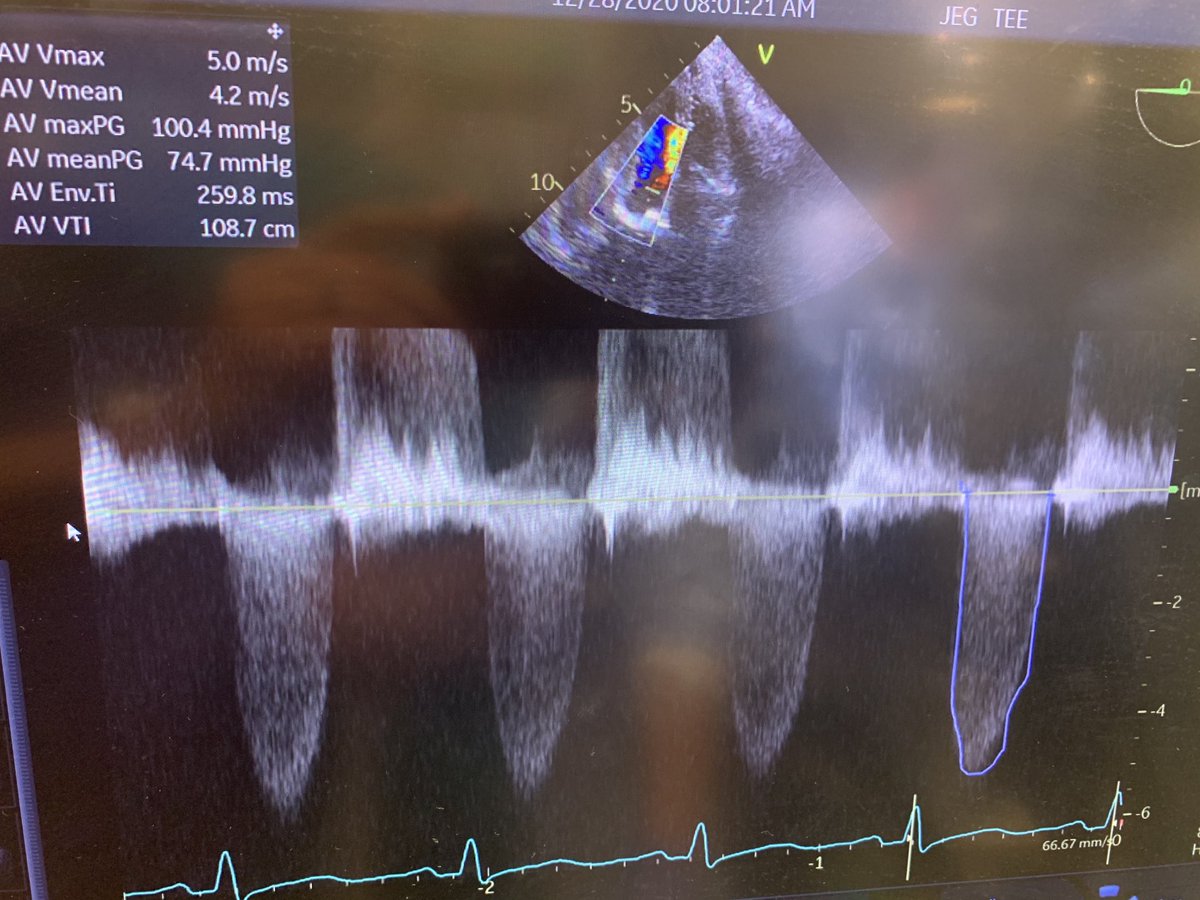 Konstadinos Plestis (@aorticsurgeonmd) on Twitter photo 57 yo Pt with severe AS bicuspid aortic valve , PAP of 70, systolic pressure of 90, LV dysfunction and ascending aortic aneurysm of 4.8 cm. Admitted with congestive heart failure what would you do? <a href="/TJUHospital/">Jefferson Health</a> <a href="/DocSavageTJU/">Michael Savage</a> <a href="/aorticlondon/">London Aorta</a> <a href="/ctsnetorg/">CTSNet</a> 57 yo Pt with severe AS bicuspid aortic valve , PAP of 70, systolic pressure of 90, LV dysfunction and ascending aortic aneurysm of 4.8 cm. Admitted with congestive heart failure what would you do? <a href="/TJUHospital/">Jefferson Health</a> <a href="/DocSavageTJU/">Michael Savage</a> <a href="/aorticlondon/">London Aorta</a> <a href="/ctsnetorg/">CTSNet</a>