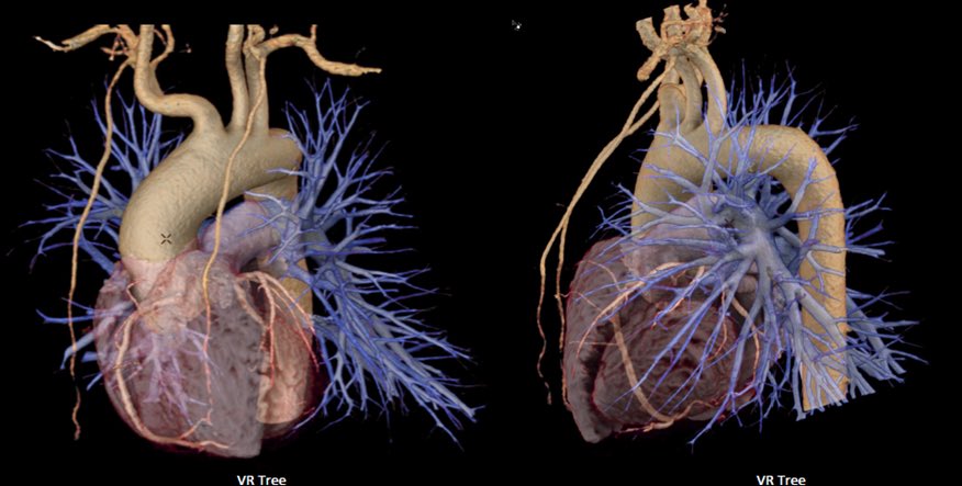 IagoMtnezSouto's tweet photo. #cardiotc #imagencardiaca #TSID #cardiovascular #Cardiographe #TAC https://t.co/2XhiUWZV9R