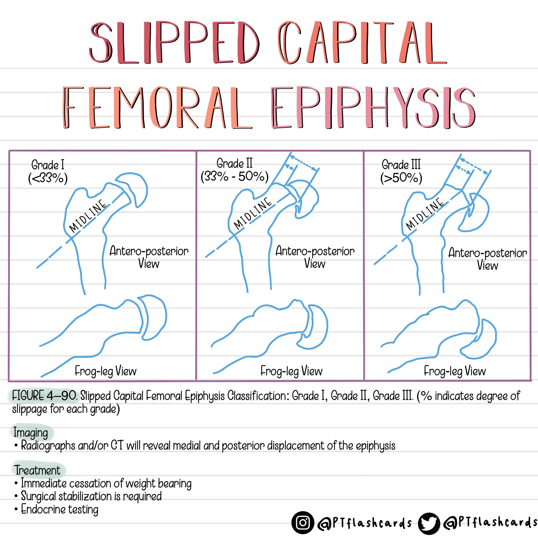 Pt Flashcards On Twitter: &quot;Slipped Capital Femoral Epiphysis (Scfe) ✨ -  Visit Our Ig Page For More Detailed Info 📲📝 References: Cuccurullo, Sara.  Physical Medicine And Rehabilitation Board Review. Demos, 2004. #Scfe #