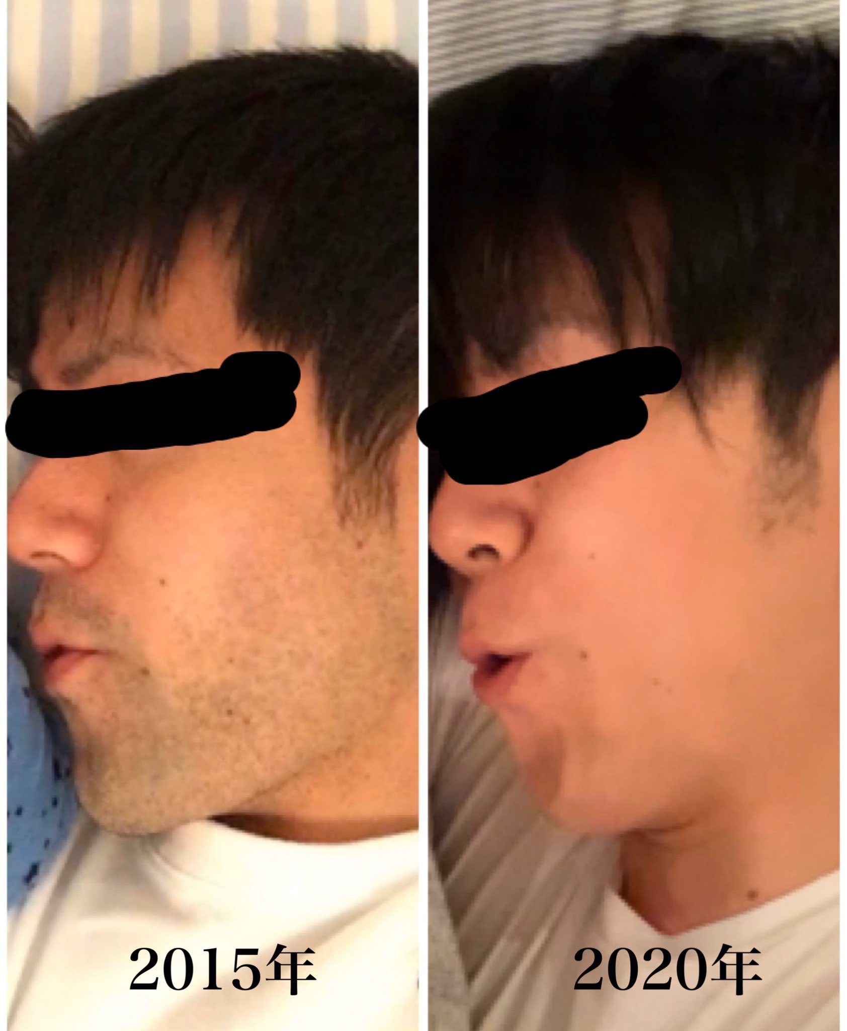 青木源太 フリーアナウンサー 僕が5年間続けているヒゲの永久脱毛について語っています どれくらい痛いの どれくらいお金がかかるの どれくらい効果があるの ヒゲが濃いことに悩んでいる男性の皆さん そして彼氏やご主人に勧めたいと思っ 青木源太 フリーアナウンサー 僕が5年間続けているヒゲの永久脱毛について語っています どれくらい痛いの どれくらいお金がかかるの どれくらい効果があるの ヒゲが濃いことに悩んでいる男性の皆さん そして彼氏やご主人に勧めたいと思っ