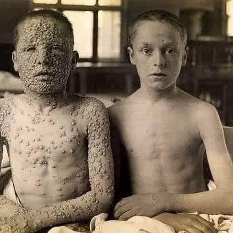 2/2 Savez-vous pourquoi vous ne voyez pas d'images terribles comme celles-ci de nos jours ? Parce que la variole est considérée comme éradiquée grâce à une des plus grandes inventions de la science moderne appelée VACCIN.

#vacina #variola #saude #ciência #avisodeGatilho