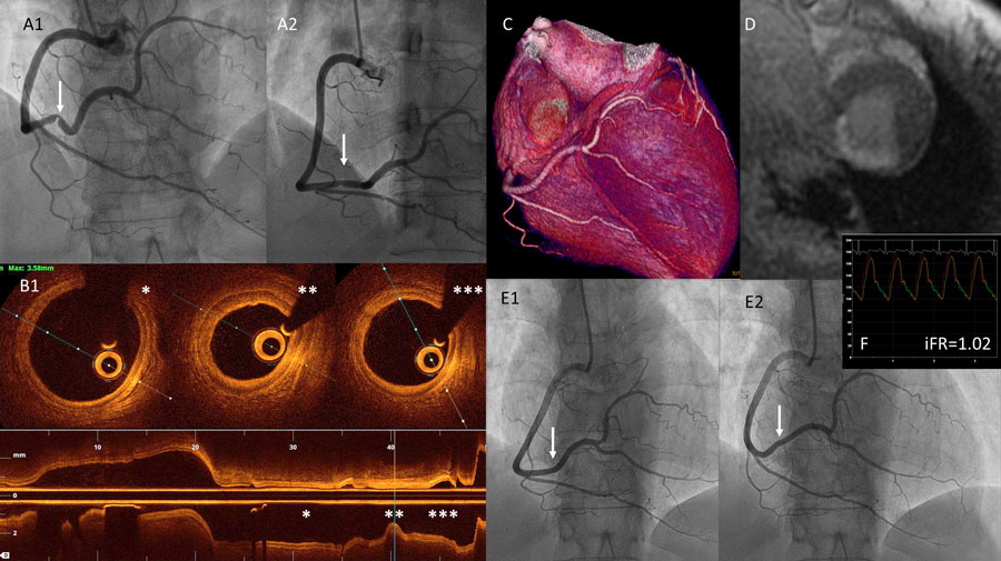 Multimodality guided management of an unusual case of #STEMI: A 47y old woman without medical history 🗒️ was admitted for chest pain with ST-segment elevation. Echocardiography showed inferior and infero-lateral wall hypokinesia... pcronline.com/tiny/url/511419 #cardiotwitter