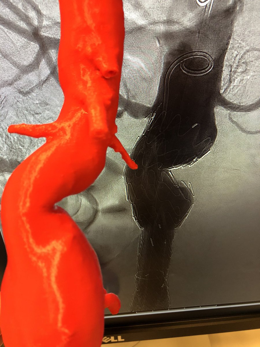 Patrick Vriens (@patrickvriens) on Twitter photo 3D printing useful in pre- operative planning of endovascular aneurysm repair, in patient information and education. <a href="/ETZnl/">ETZ</a> <a href="/Til_Surg/">Chirurgen Tilburg</a> <a href="/3DLab_ETZ/">ETZ In-Hospital 3D Lab</a> <a href="/Brouwers_3D/">Lars Brouwers, MD, PhD, MSc</a> 3D printing useful in pre- operative planning of endovascular aneurysm repair, in patient information and education. <a href="/ETZnl/">ETZ</a> <a href="/Til_Surg/">Chirurgen Tilburg</a> <a href="/3DLab_ETZ/">ETZ In-Hospital 3D Lab</a> <a href="/Brouwers_3D/">Lars Brouwers, MD, PhD, MSc</a>