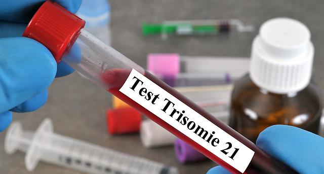 Dt_Aerzteblatt's tweet image. Pränataldiagnostik: In Europa wird nur jedes zweite Kind mit Down-Syndrom geboren:  Boston – Die zunehmende Verbreitung der Pränataldiagnostik hat in Europa dazu geführt, dass 54 % aller Schwangerschaften mit Down-Syndrom… dlvr.it/RpXBRZ #Trisomie21 #Studie #EJHG