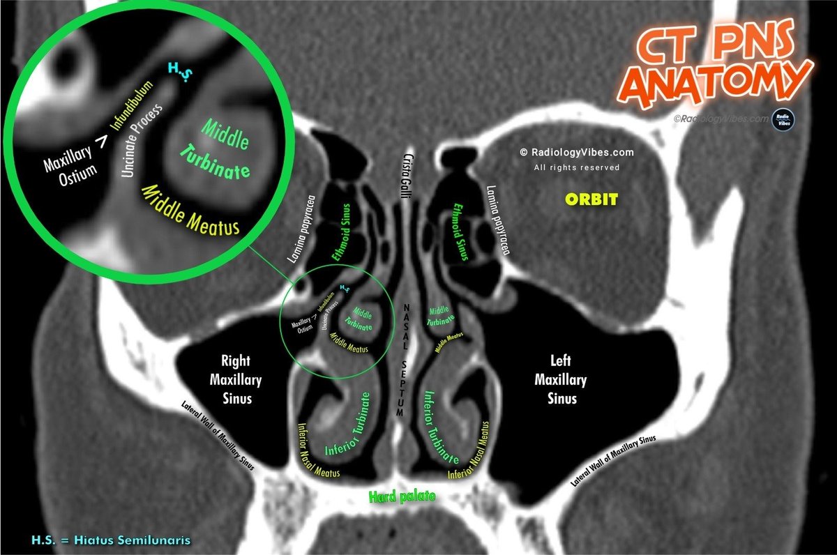 Paranasal sinus anatomy on CT, image size:1200x796