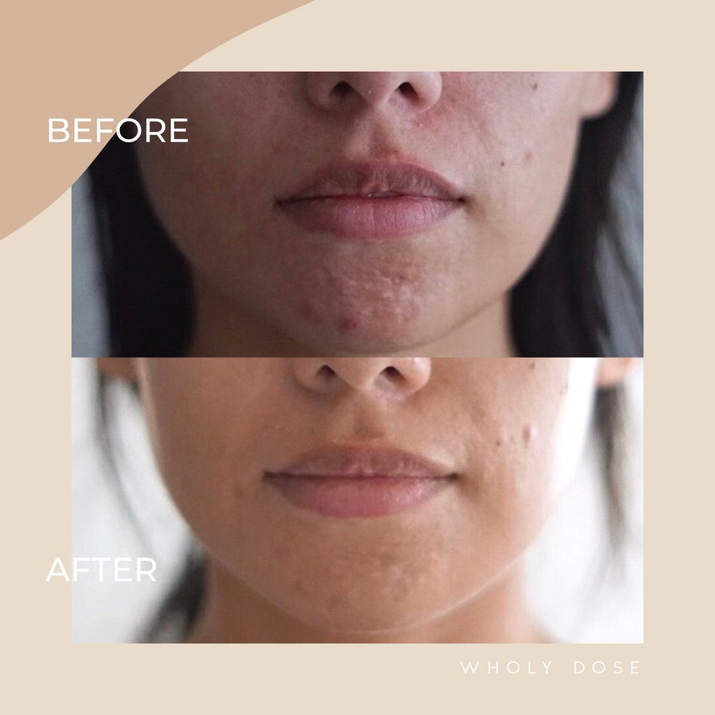 Here to help you get wow-worthy results. 😍 

View more Wholy Dose before and after photos at wholydose.com.

#wholydose

#results #beforeandafter #collagen