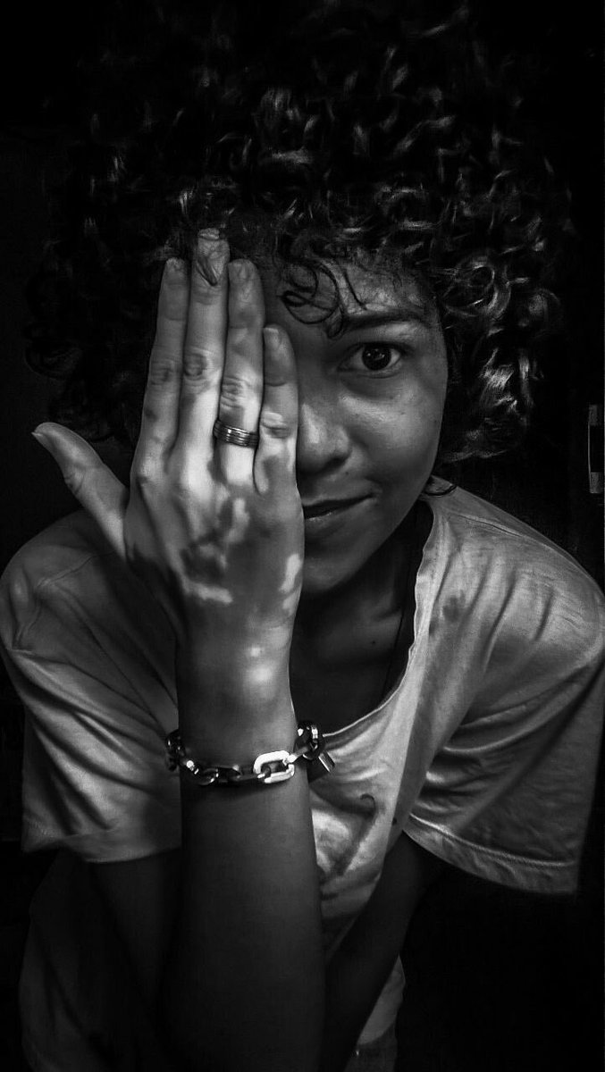 Vitiligo Project tweet media