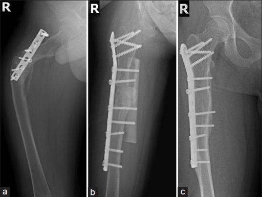 NIH_NIAMS's tweet photo. Osteogenesis imperfecta is a disease that causes your bones to break easily. It is also called brittle bone disease. [Image via @nationallibraryofmedicine] https://t.co/SSHOqhutcI https://t.co/zVC9K9C0Wx