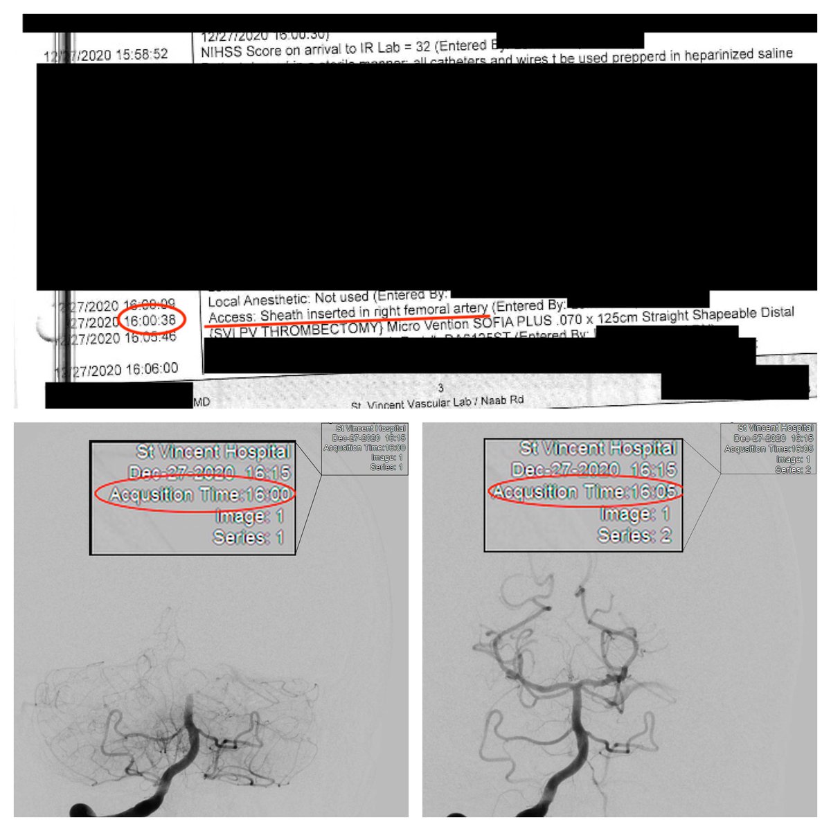 AmuluruKrishna's tweet image. A new record for us — Groin access to recanalization in 4 MIN, 22 SEC.

No microcatheter; ADAPT alone. 
Patient presented unconscious, basilar tip occlusion. Awake and moving all extremities POD1.

#TimeIsBrain #NeuroIR #Stroke #NoStrokeLeftBehind